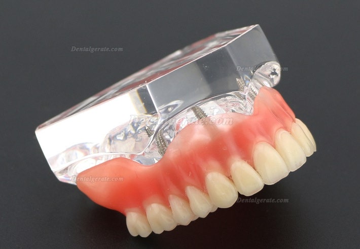 Anatomisches Modell der Zahnz&auml;hne &Uuml;berprothese Superior mit 4 Implantaten Demo Modell 6001